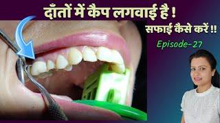 how to clean crown teeth at home |दाँतों में कैप लगवाई है,सफाई कैसे करें danto ki safai ।Episode -27