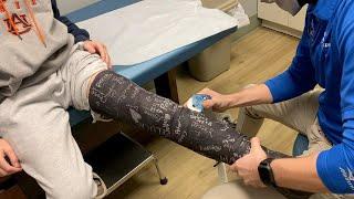 BROKEN TIBIAL EMINENCE - FULL LEG CAST REMOVAL AND NEW BRACE