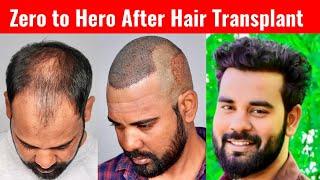 Life Changing Hair Transformation | Unbelievable Bald to Bold Journey | Best Hair Transplant Clinic