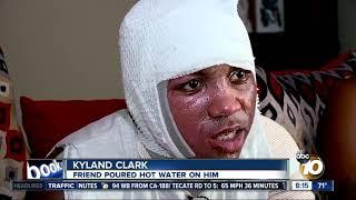 Teen injured after 'hot water challenge'