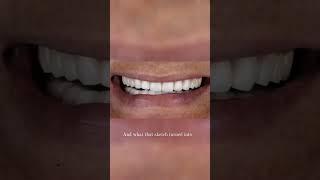 Energetic 80+ yr old gentleman wanted to improve his smile and multiple teeth issues.