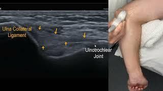 Sonoanatomy of the common flexor tendon of the elbow.