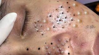 Big Cystic Acne Blackheads Extraction Blackheads & Milia, Whiteheads Removal Pimple Popping # 2498