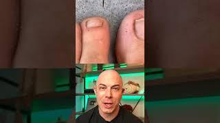 Doctor reacts to an extremely ridiculous splinter removal! #dermreacts #doctorreacts #splinter