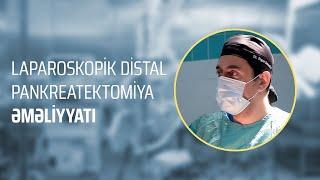 Dr. Elgün Səmədov - Laparoskopik distal pankreatektomiya əməliyyatı