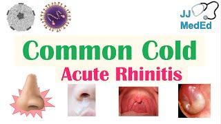 Common Cold (Acute Rhinitis) | Causes (ex. Coronaviruses), Risk Factors, Transmission, Symptoms