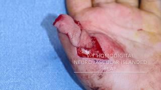 Homodigital neurovascular islanded flap for thumb reconstruction