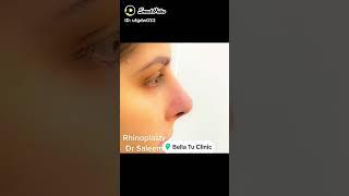 Rhinoplasty surgery behore & after in Pakistan by dr Saleem plastic surgeon. #rhinoplasty