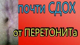 Гнойный ПЕРИТОНИТ. чуть не УМЕР от аппендицита.