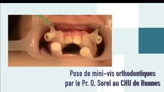 SmileTech, Guided Surgery