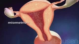 ¿Qué es la endometriosis JC