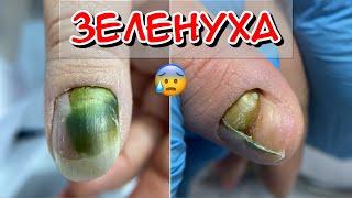 Pseudomonas aeruginosa / Sigegnoyka / Green nail / Onycholysis