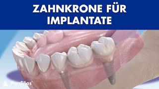 FEHLENDE ZÄHNE? Vier Lösungen mit dem ZAHNKRONE für implantate zum Ersetzen ©