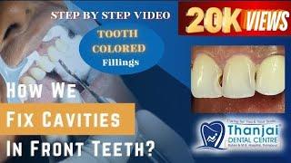 How to fix cavities between front teeth?| Composite filling video| How dentist remove tooth decay?