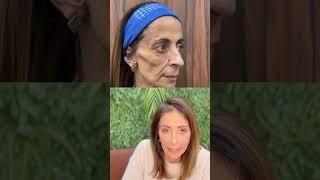 Dra Tereza Scardua, caso sensacional de harmonização facial, incrível!