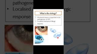 What is Giant Papillary Conjunctivitis (GPC)?