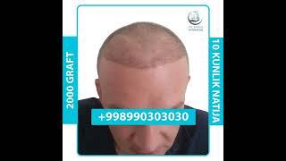 Bu mijozimizga 2000 graft ekilgan edi.10 kunlik holatga baho bering.+998990303030