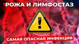 РОЖА: почему возникает при отеке и чем рискует пациент с лимфостазом