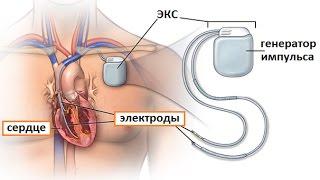 Установка кардиостимулятора: показания, этапы операции и принцип лечения аритмии сердца