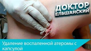 Удаление воспаленной атеромы с капсулой