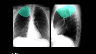 CXR Anatomy