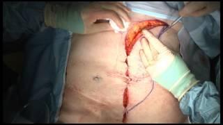 Vertical Rectus Abdominis Myocutaneous (VRAM) Flap after APR for Rectal Cancer