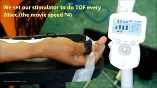 3-Neuromuscular monitoring, TOF for induction