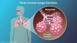 Understanding COPD