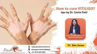 सफेद दाग जड से ठीक करे | How to cure VITILIGO? tips by Dr. Smita Patil