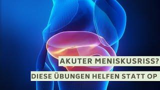 Akuter Meniskusriss? Probiere diese Übungen vor einer Operation!