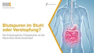 Polypen im Darm: Erkennung und Behandlung am Rems-Murr-Klinikum Schorndorf | Rems-Murr-Kliniken