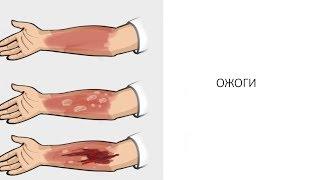Первая помощь при термических ожогах