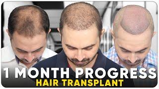 Hair Transplant in Jabalpur | Best Results & Cost of Hair Transplant in Jabalpur