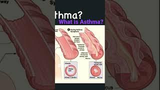 What is Asthma   How does it affect the lungs   Link to video in description!