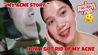 MY ACNE STORY + 3 EFFECTIVE PRODUCTS I USED + HOW I GOT RID OF MY ACNE By Joy Guamos