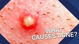 What Causes Acne? | Earth Science