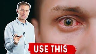 Best Natural Pink Eye (Conjunctivitis) Remedy