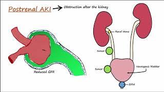 Acute Kidney Injury (AKI) - Prerenal,Intrarenal,Postrenal