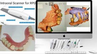 Intraoral scanner for RPD