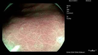 H. pylori Diagnosis with Magnifying Endoscopy