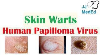 Overview of Skin Warts (Verrucae) | What Causes Them? Who Gets Them? | Subtypes and Treatment