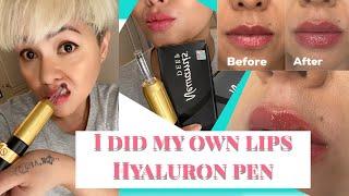 HYALURON PEN, I DID MY OWN LIPS, WOW!! Tutorial and Result