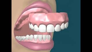 Dental Video for Upper Denture - The Tooth