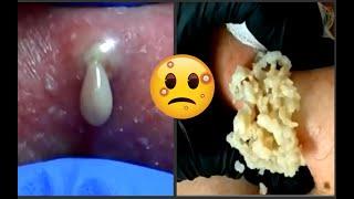 Super Big Pimples Popping! Bigger Pimples/ Pimple Popping Compilation! ВЫДАВЛИВАНИЕ ОГРОМНЫЕ ПРЫЩИ