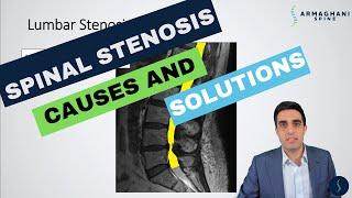 Lumbar Spinal Stenosis - What is the cause and how will I get better?