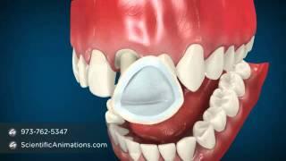 Dental Cap Procedure -- Tooth Caps