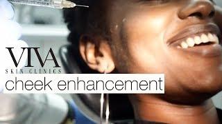 CHEEK ENHANCEMENT WITH DERMAL FILLER | VIVA SKIN CLINICS