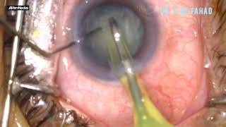 Phacoemulsification by Dr. Fahad, NIO