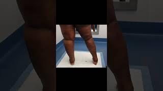 Lipedema Awareness Month: 360° Leg Liposuction Before & After | Dr. Thomas Su | Tampa, Florida