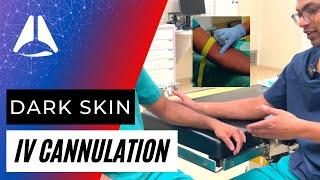 IV Cannulation of dark skin & what I do when I mess up | #ivcannulation #anesthesia #anesthesiology